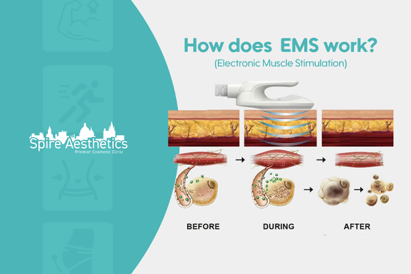 EMS treatment for post pregnancy weight loss treatment Central Milton Keynes