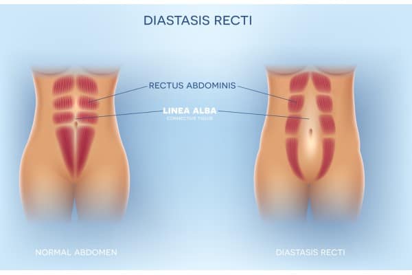 What Non-Surgical Options Are Available for Diastasis Recti Central Milton Keynes?