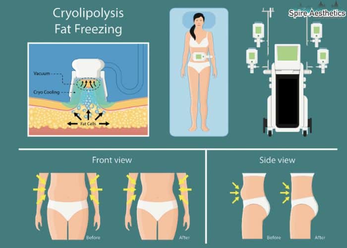 Image of diet and fat freezing combined for best results for Spire Aesthetics Central Milton Keynes