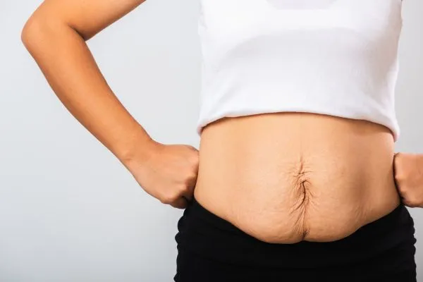 Image of a woman's stomach after weight loss with sagging skin following a gastric band Central Milton Keynes