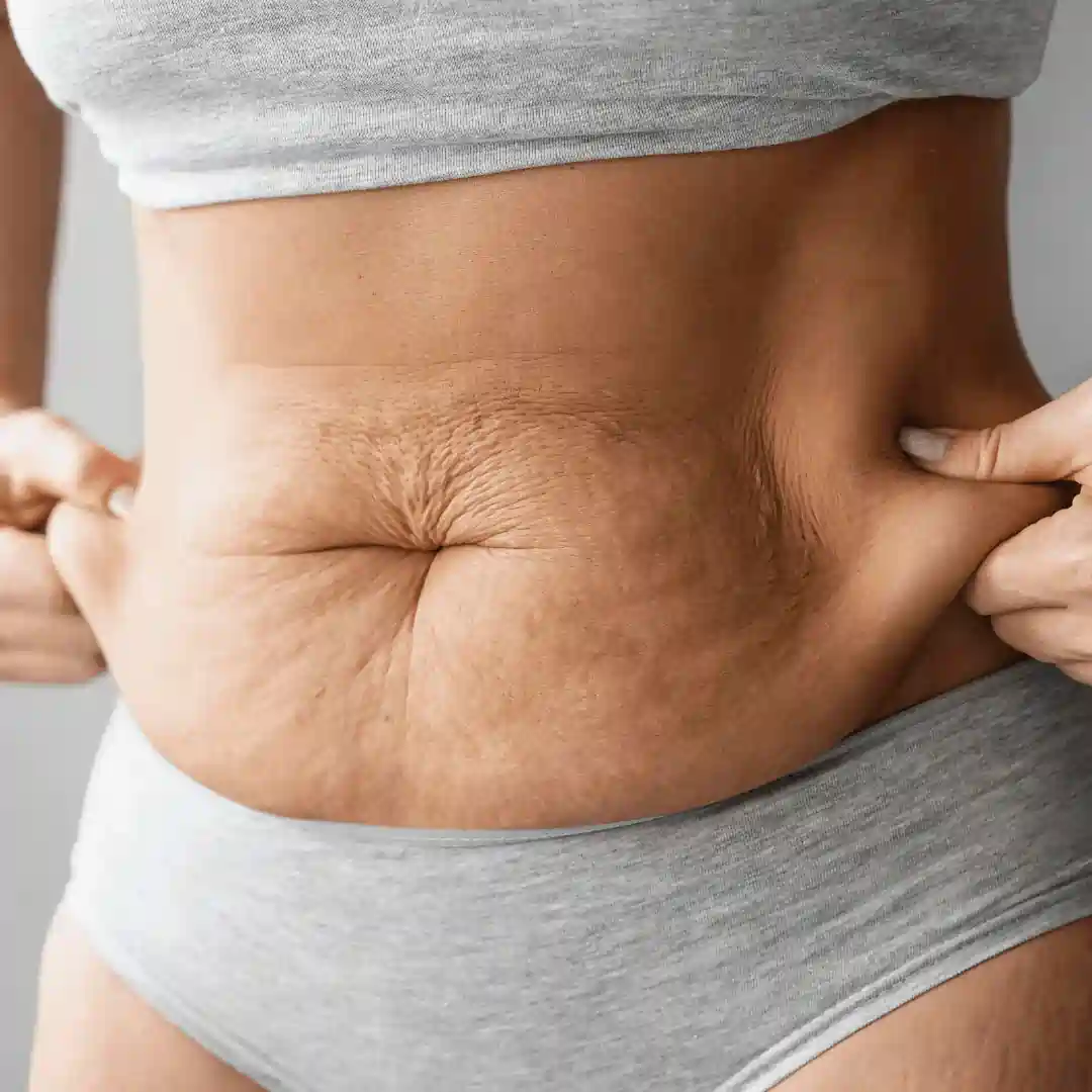 Is It Normal to Have Loose Skin After Pregnancy Central Milton Keynes?