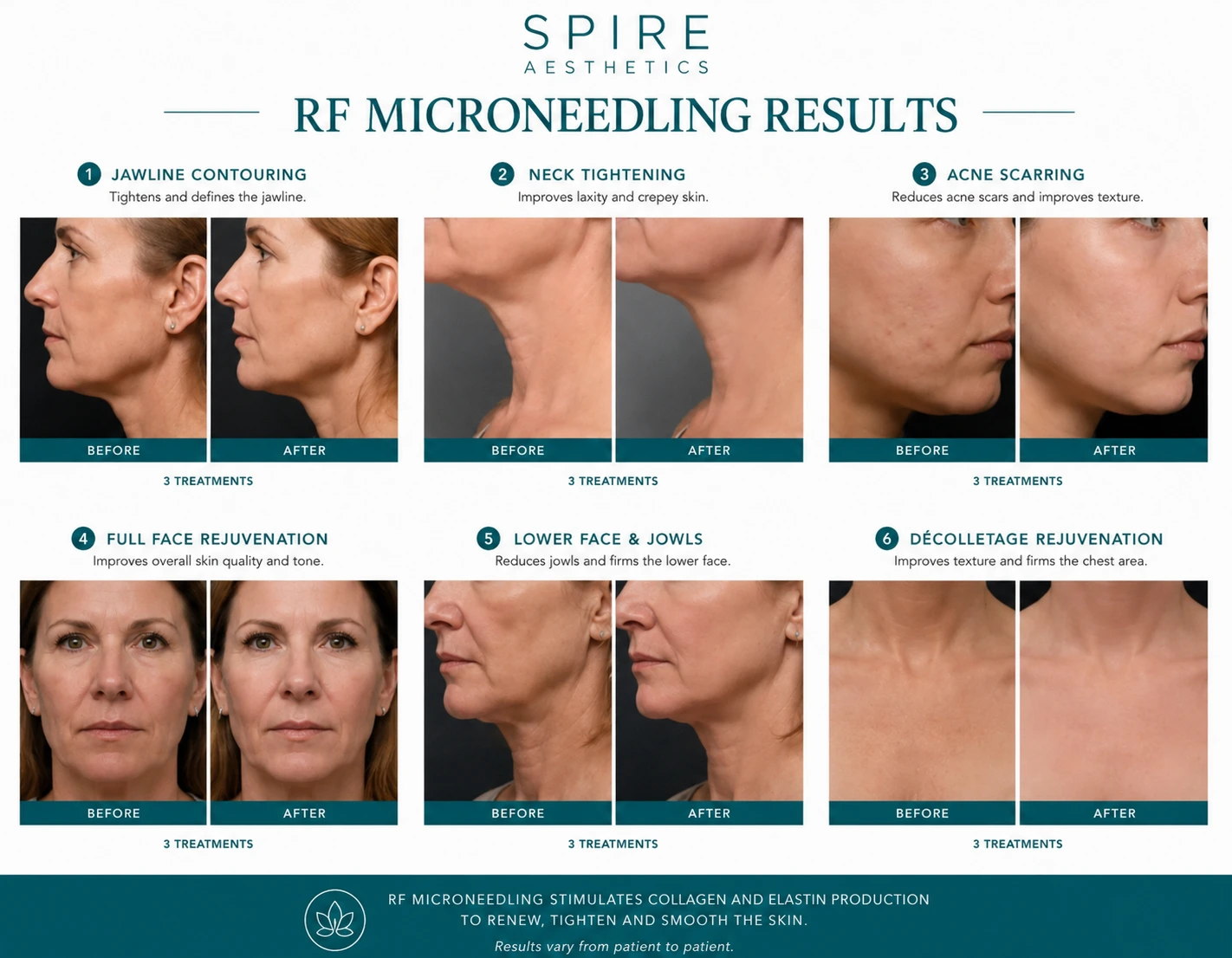 RF Microneedling Skin tightening Central Milton Keynes results