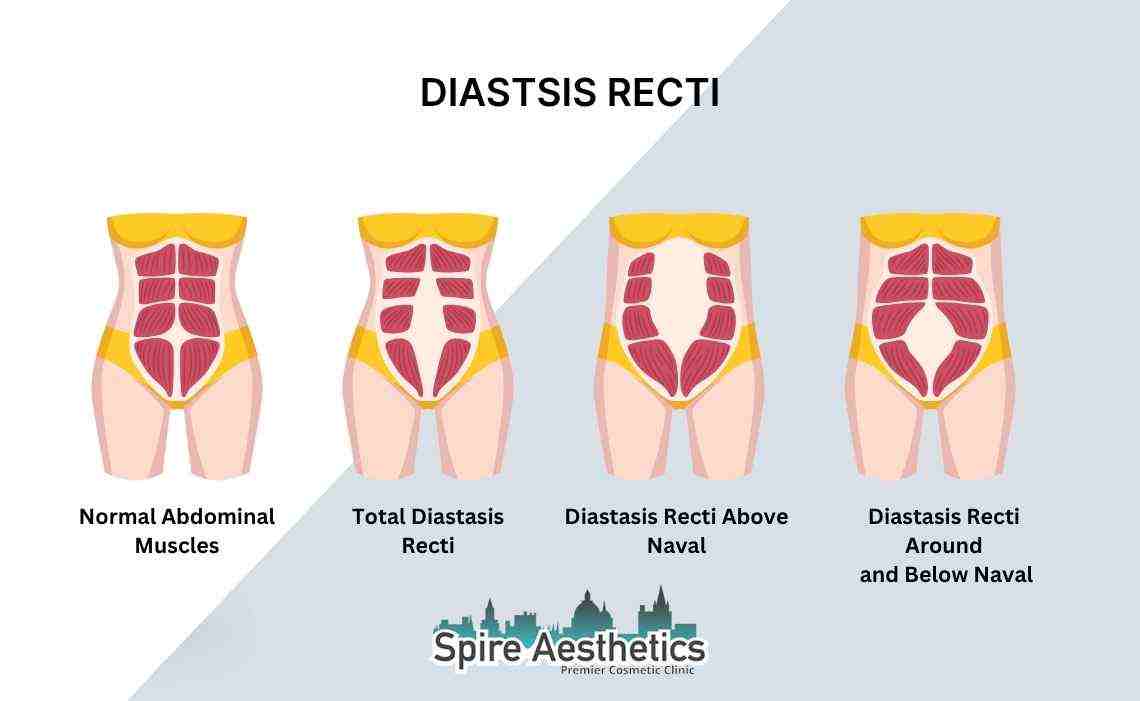 Is Non-Surgical Diastasis Recti Treatment Right for You? Common Concerns Answered Central Milton Keynes
